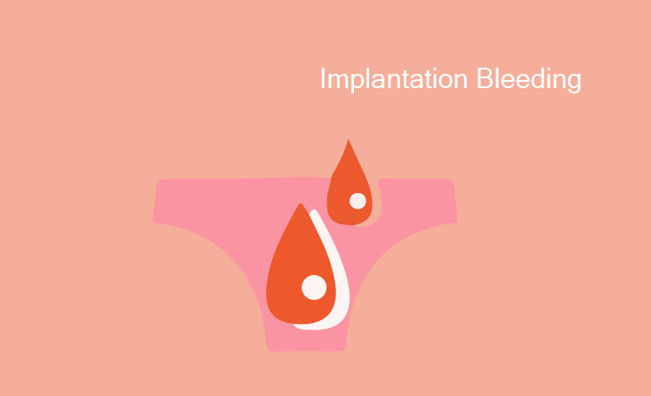 Implantation Bleeding